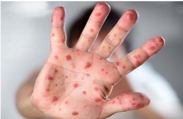 হাম ও হামের উপসর্গ নিয়ে আরও ৭ শিশুর মৃত্যু